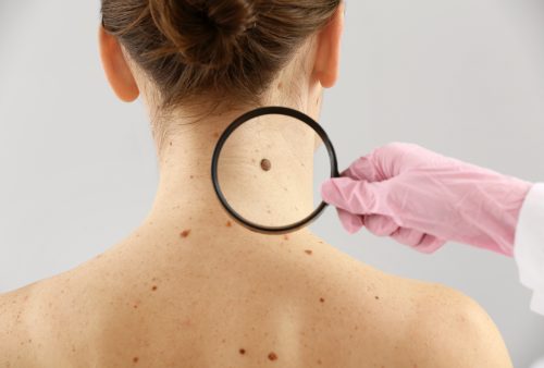 skin cancer melanom