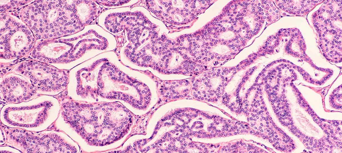 ecpc rare cancers banner